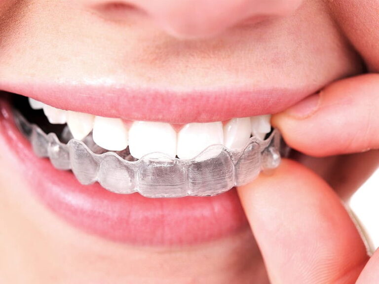 Invisalign Braces
