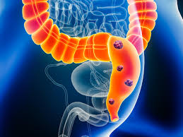 Colon Cancer