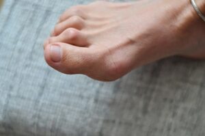 Hammer Toe