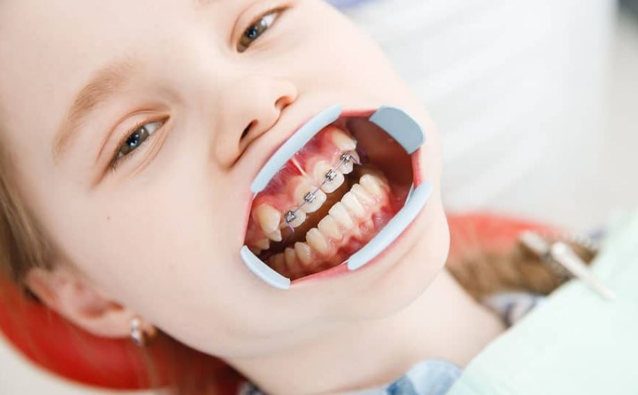 Braces Are Only for Kids
