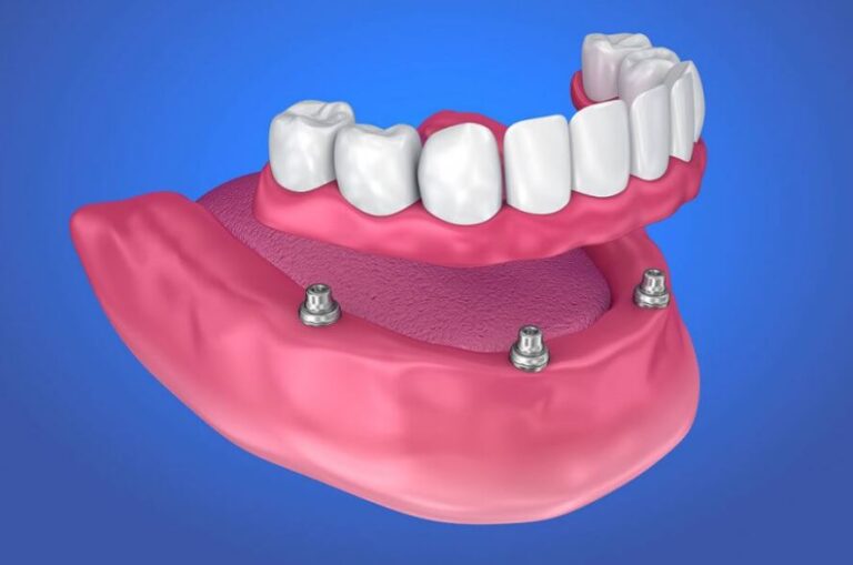 denture implants