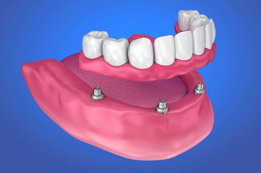 denture implants