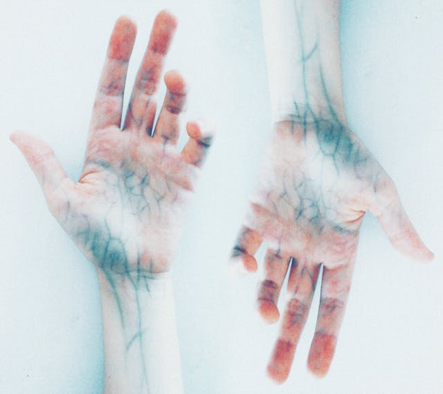 Spider Veins