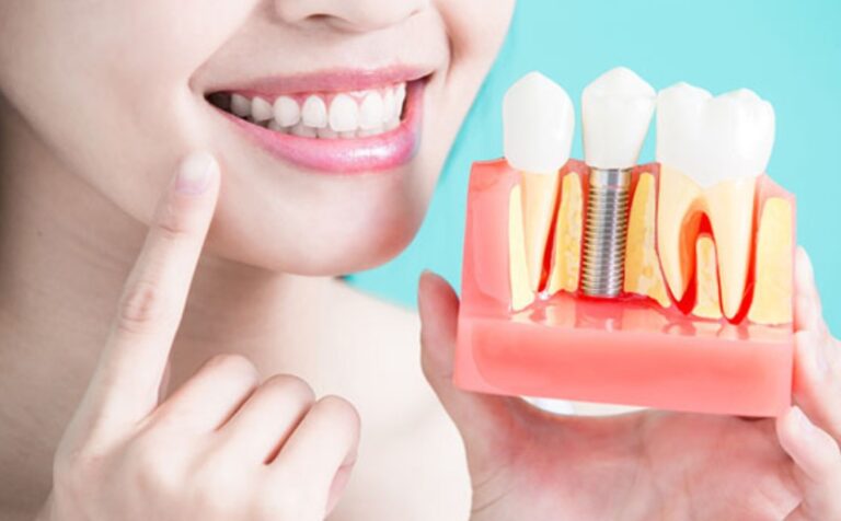 Dedham tooth implant