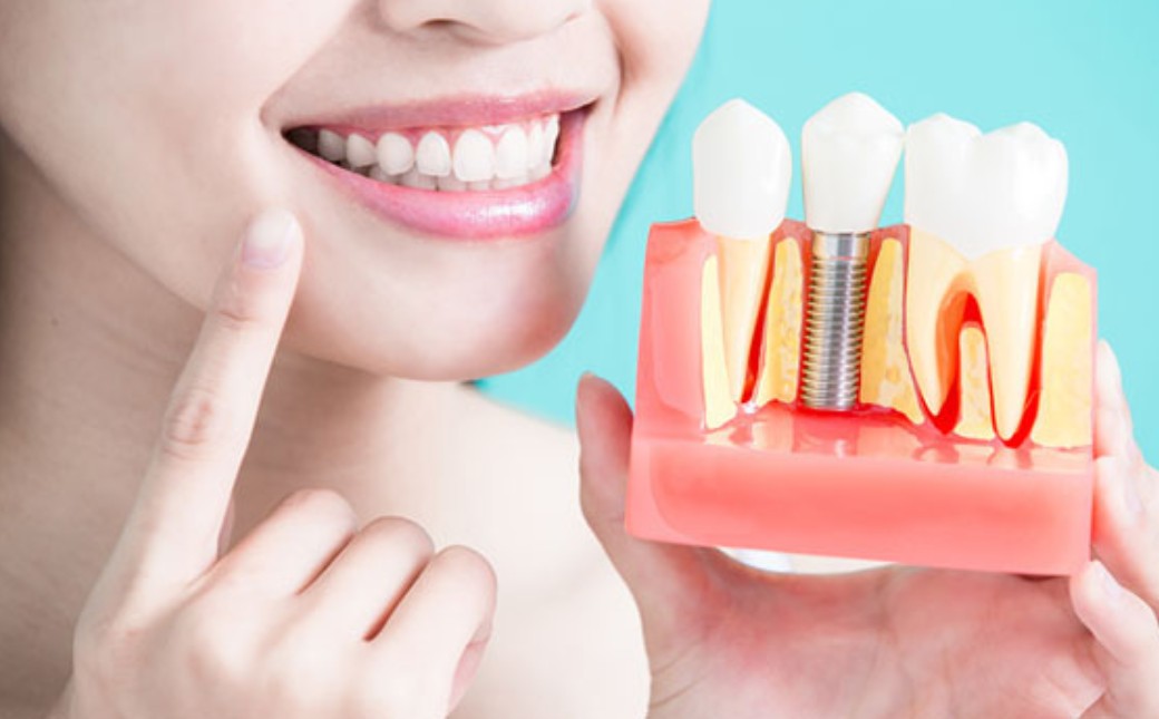 Dedham tooth implant