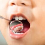 Risk Of Childhood Cavities