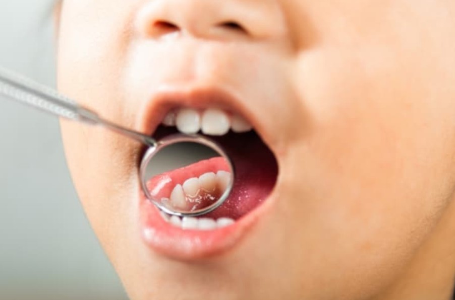 Risk Of Childhood Cavities